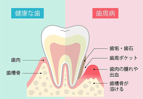 歯周病