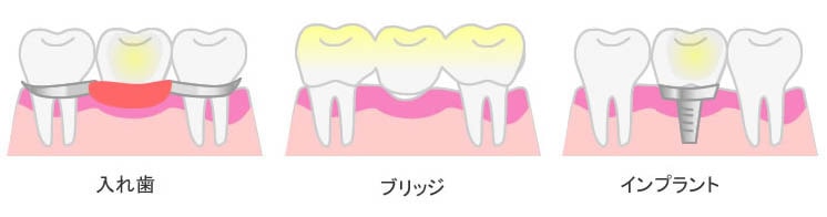 入れ歯、ブリッジ、インプラント